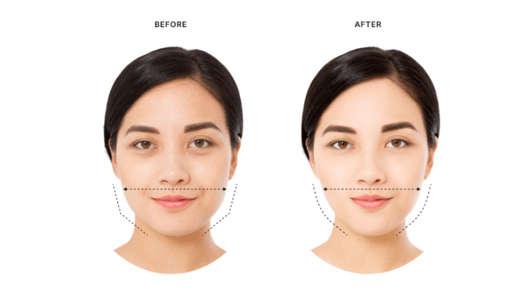 Masseter Botox Treatment